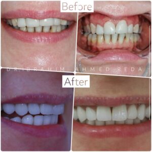 smile veneers in abu dhabi UAE ابتسامة الفينيرز في ابوظبي الرياض جنوب الشامخة