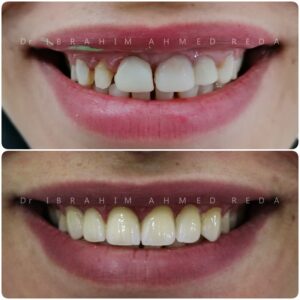 smile veneers in abu dhabi UAE ابتسامة الفينيرز في ابوظبي الرياض جنوب الشامخة