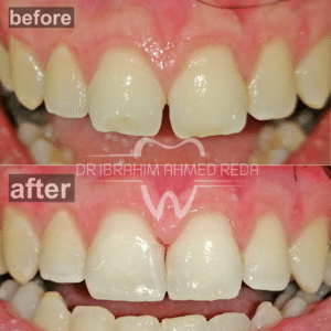 غلق فلجة بين الاسنان الامامية بالحشو التجميلي في أبوظبي closing gaps between front teeth in abu dhabi uae