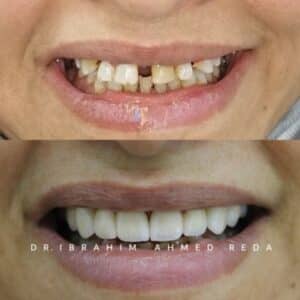 عمل ابتسامة في ابوظبي Hollywood smile in abu dhabi teeth veneers and crown in uae