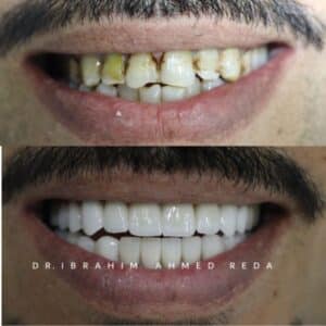 smile veneers in abu dhabi UAE ابتسامة الفينيرز في ابوظبي الرياض جنوب الشامخة
