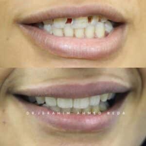 smile veneers in abu dhabi UAE ابتسامة الفينيرز في ابوظبي الرياض جنوب الشامخة