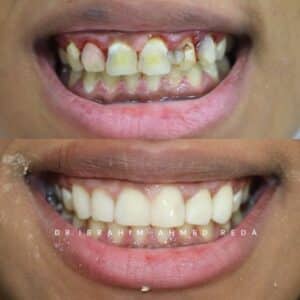 smile veneers in abu dhabi UAE ابتسامة الفينيرز في ابوظبي الرياض جنوب الشامخة