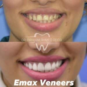 smile veneers in abu dhabi UAE ابتسامة الفينيرز في ابوظبي الرياض جنوب الشامخة
