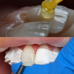 composite bonding or teeth veneers of porcelain?